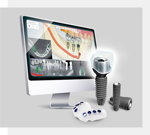 디지털 임플란트